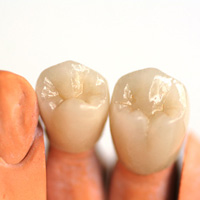 Zahnersatz - Zahnfarbe anpassen